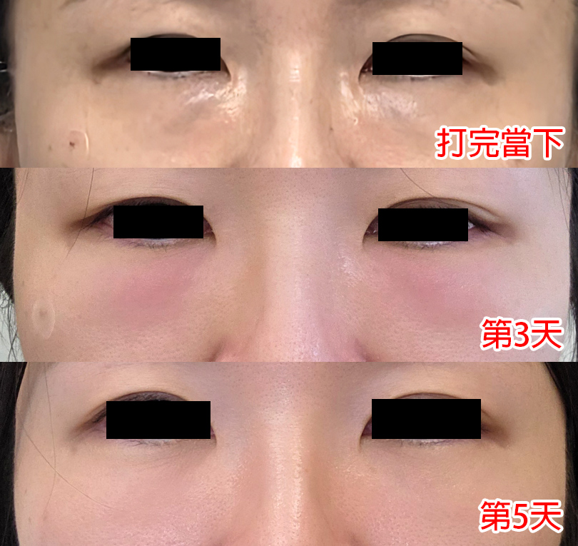 韓國醫美推薦｜江南奧恩皮膚科，麗珠蘭白盒(眼周)心得，中文服務，價錢、恢復期一次分享！